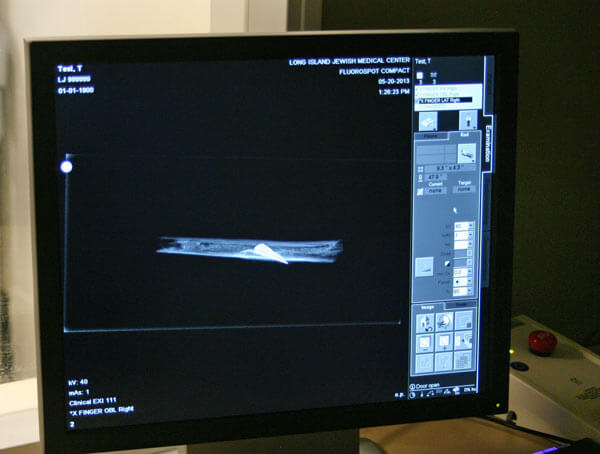 Hospital examines war wound of ancient Greek veteran