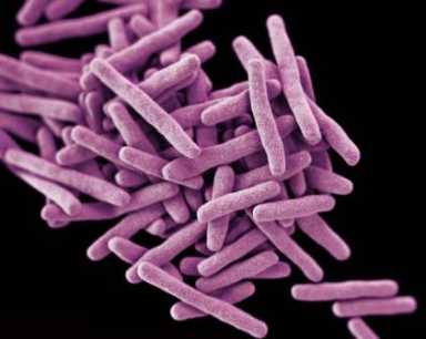 tuberculosis