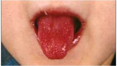 Kawasaki_symptoms_1